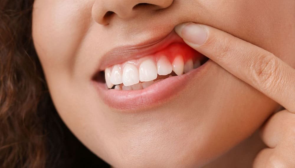 How to Prevent Gum Disease?