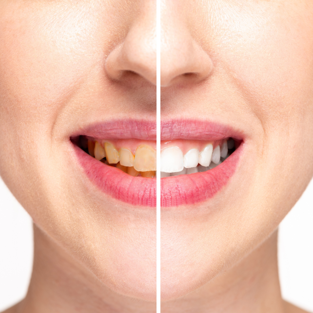 Teeth polishing and cleaning Calgary