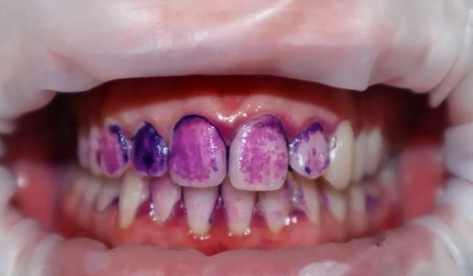 Guided-Biofilm-Therapy